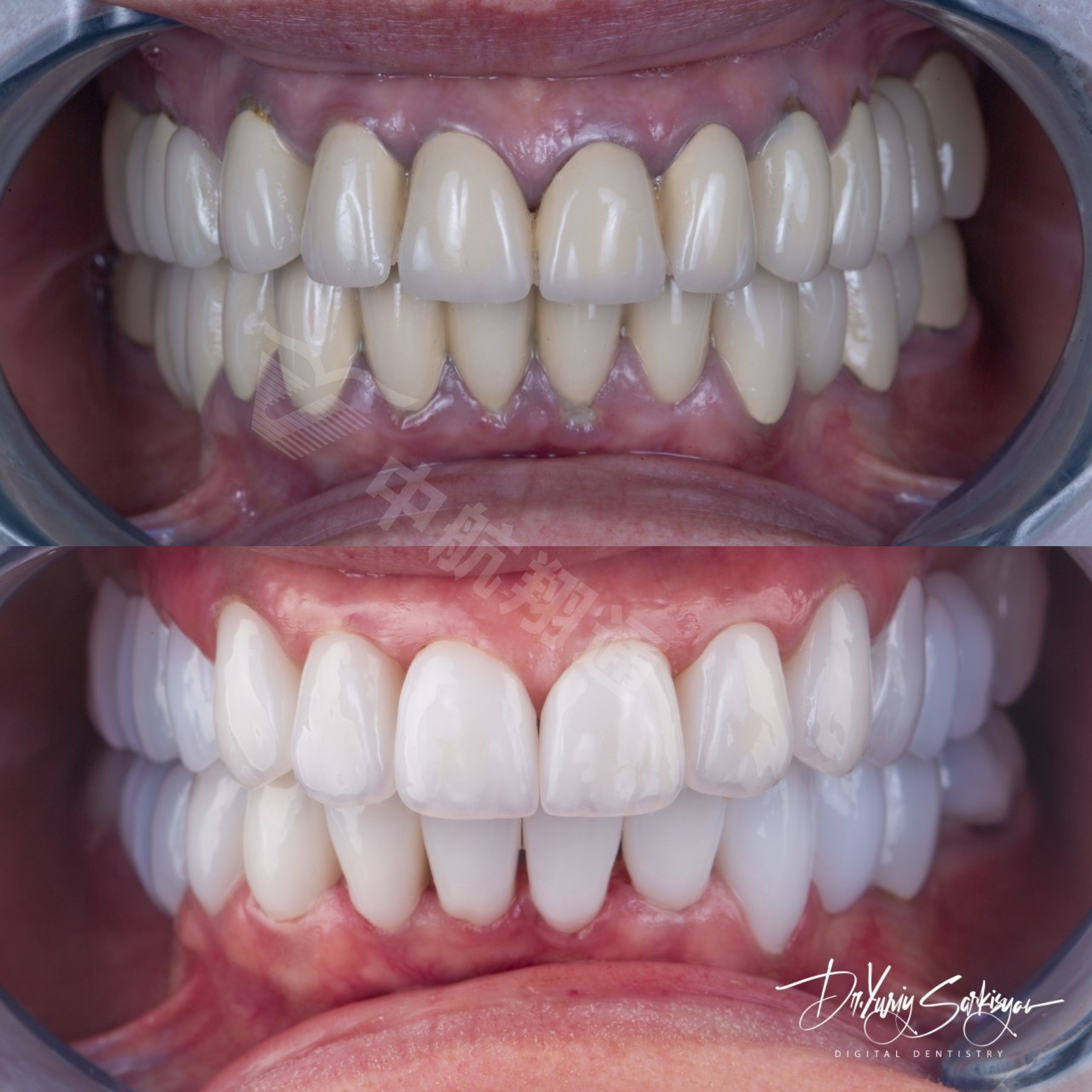 XTCERA 3D White XTCERA 3D White