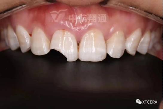 前牙區(qū)美學(xué)修復(fù)一例|全冠修復(fù)病例分享