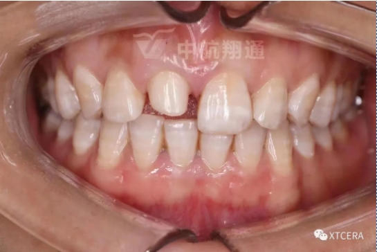 前牙區(qū)美學(xué)修復(fù)一例|全冠修復(fù)病例分享