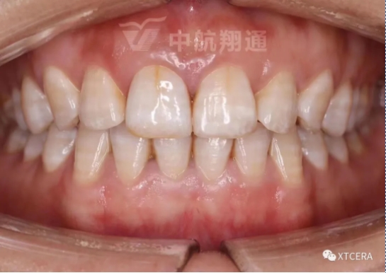 前牙區(qū)美學(xué)修復(fù)一例|全冠修復(fù)病例分享
