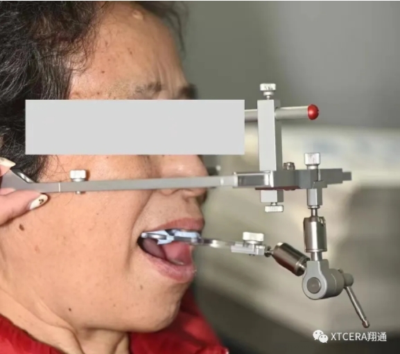 全口氧化鋯美學修復臨床病例分享