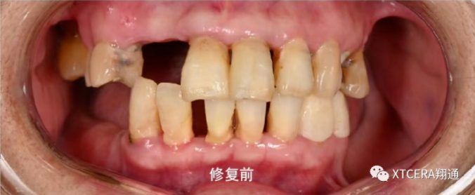 全口氧化鋯美學修復臨床病例分享