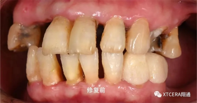 全口氧化鋯美學修復臨床病例分享