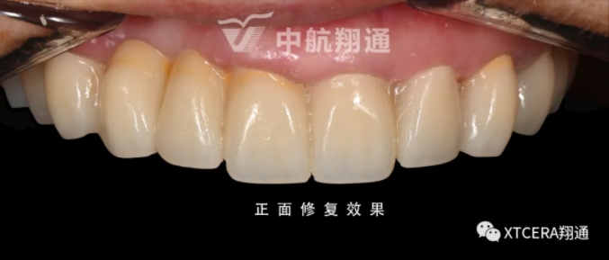 全口氧化鋯美學修復臨床病例分享