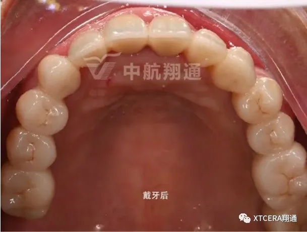 全口氧化鋯美學修復臨床病例分享