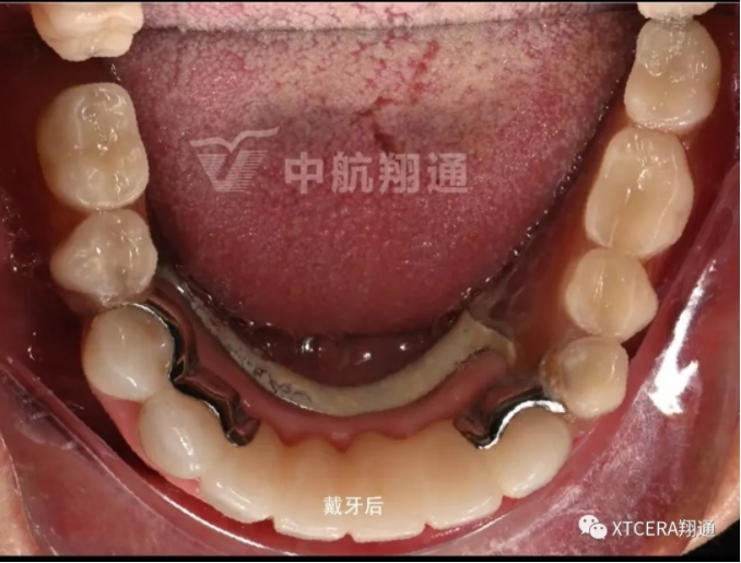全口氧化鋯美學修復臨床病例分享