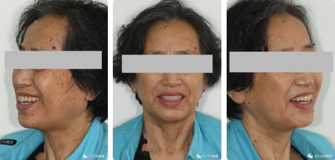 全口氧化鋯美學修復臨床病例分享
