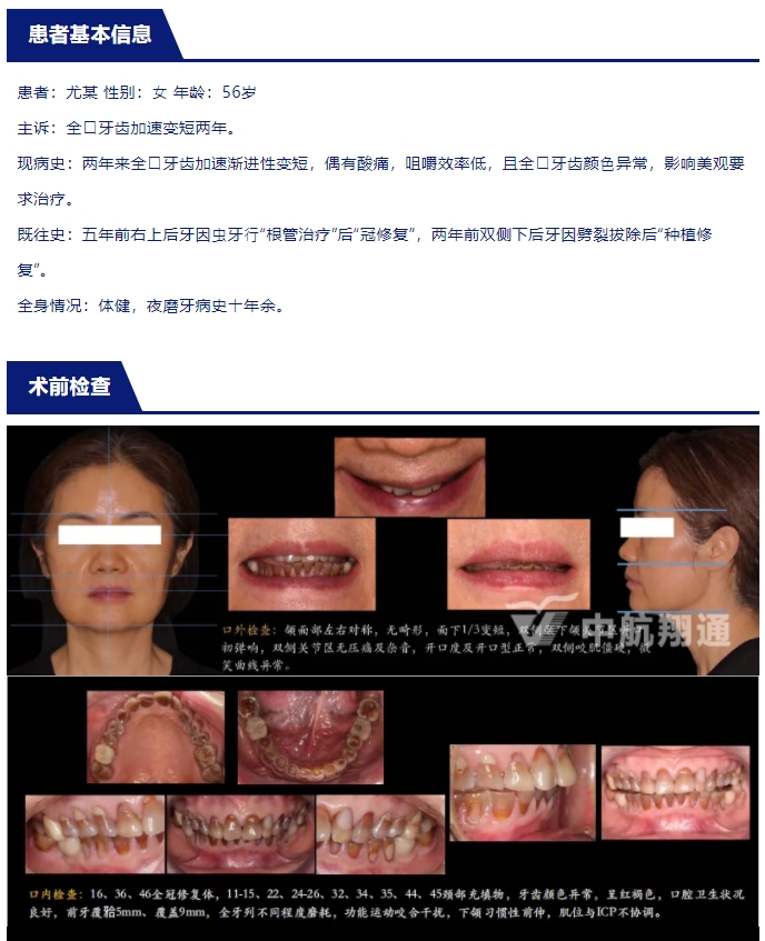 多學(xué)科聯(lián)合治療重度磨耗咬合重建?例