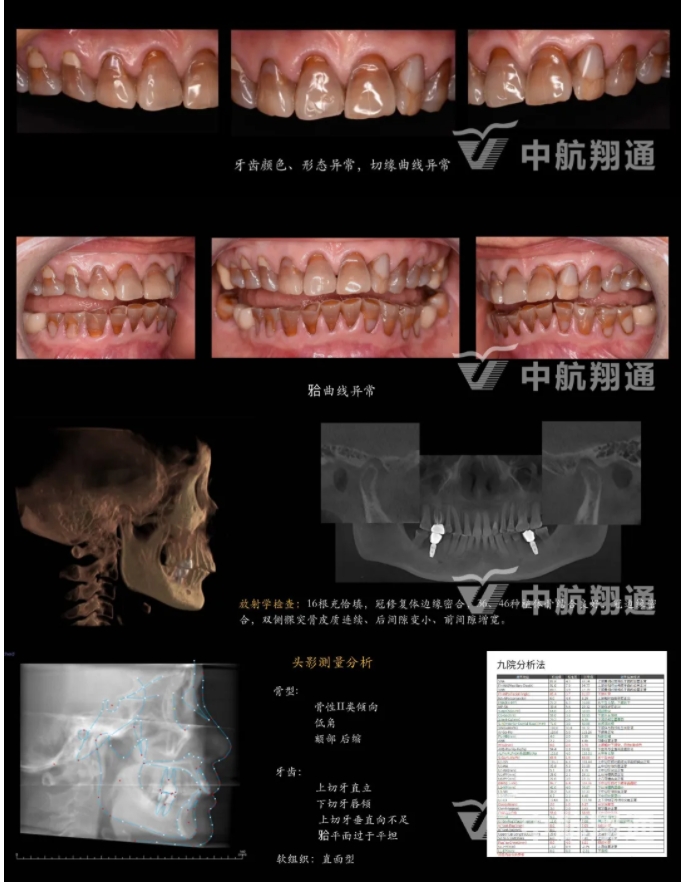 多學(xué)科聯(lián)合治療重度磨耗咬合重建?例