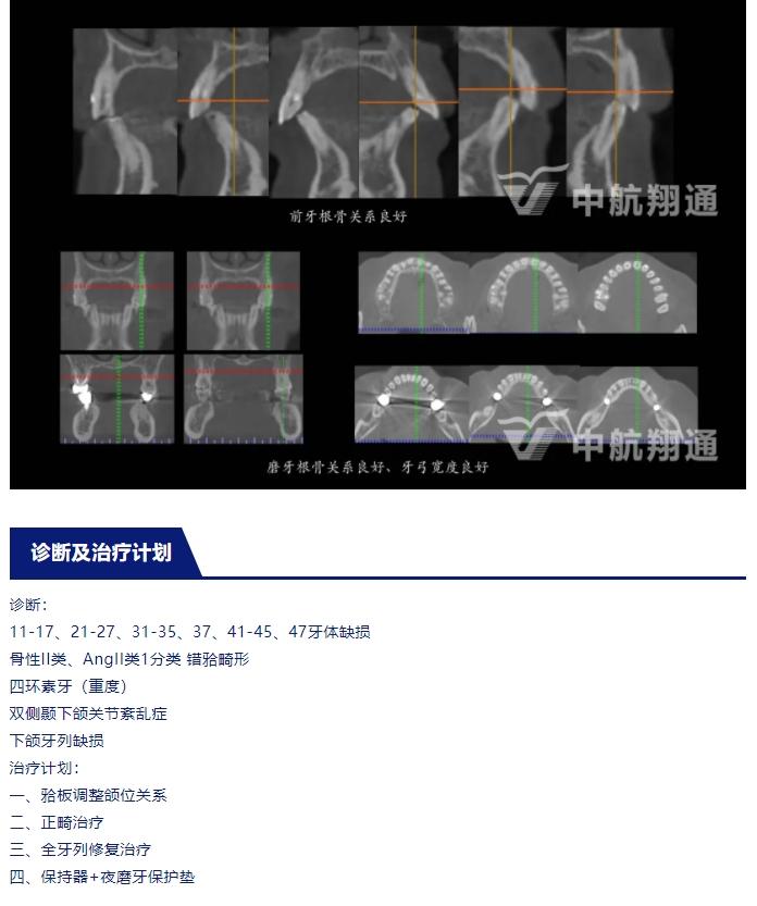 多學(xué)科聯(lián)合治療重度磨耗咬合重建?例