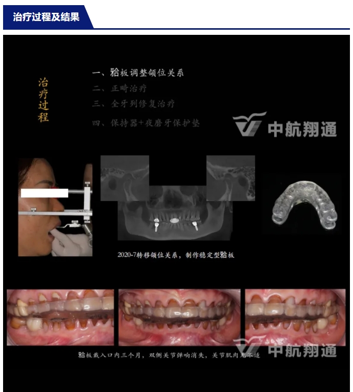 多學(xué)科聯(lián)合治療重度磨耗咬合重建?例