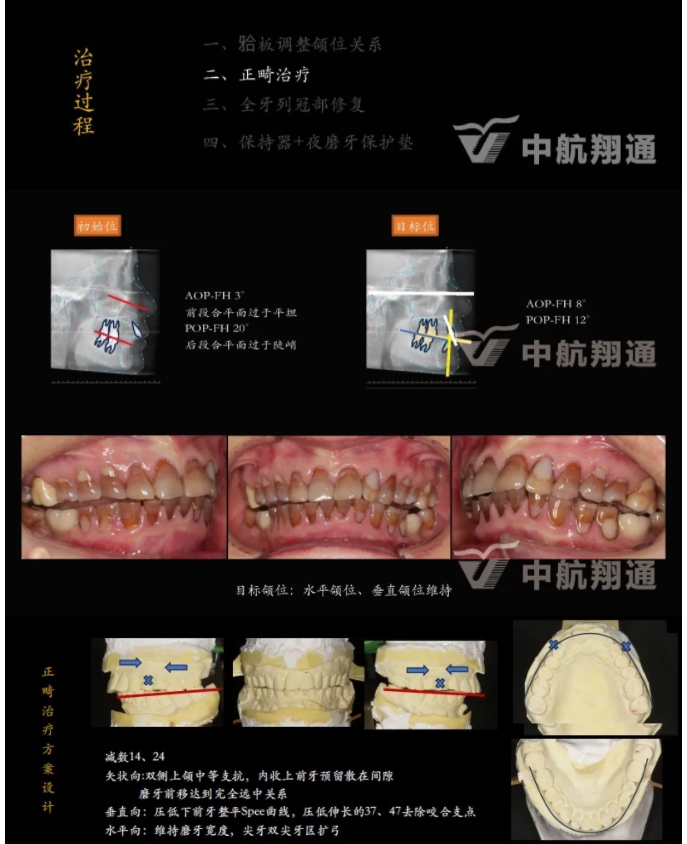 多學(xué)科聯(lián)合治療重度磨耗咬合重建?例