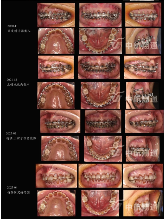 多學(xué)科聯(lián)合治療重度磨耗咬合重建?例