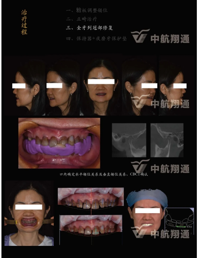 多學(xué)科聯(lián)合治療重度磨耗咬合重建?例