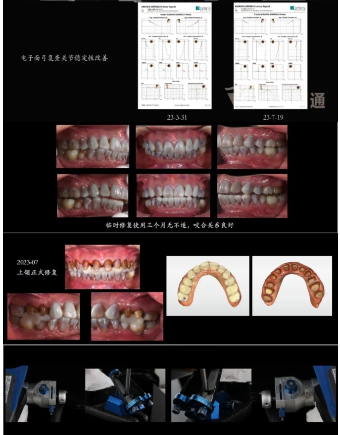 多學(xué)科聯(lián)合治療重度磨耗咬合重建?例