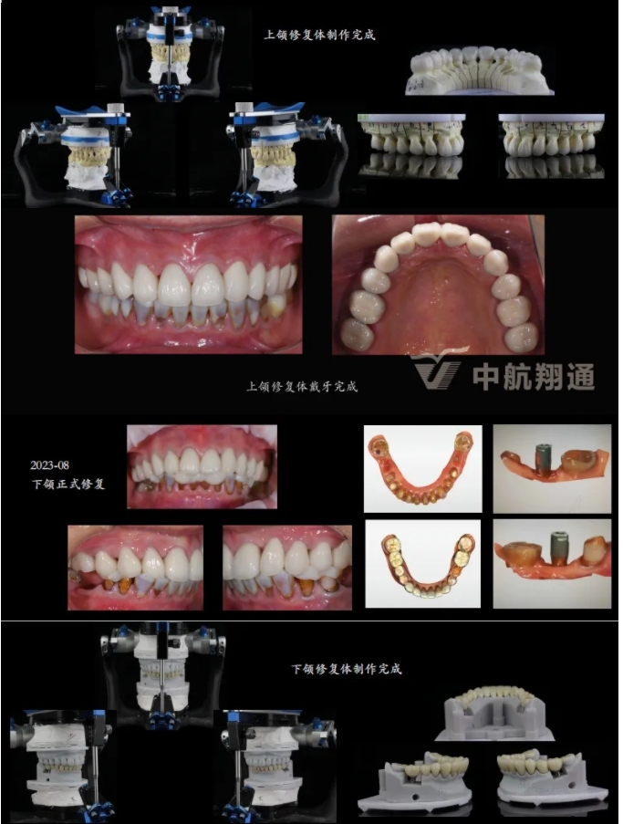 多學(xué)科聯(lián)合治療重度磨耗咬合重建?例