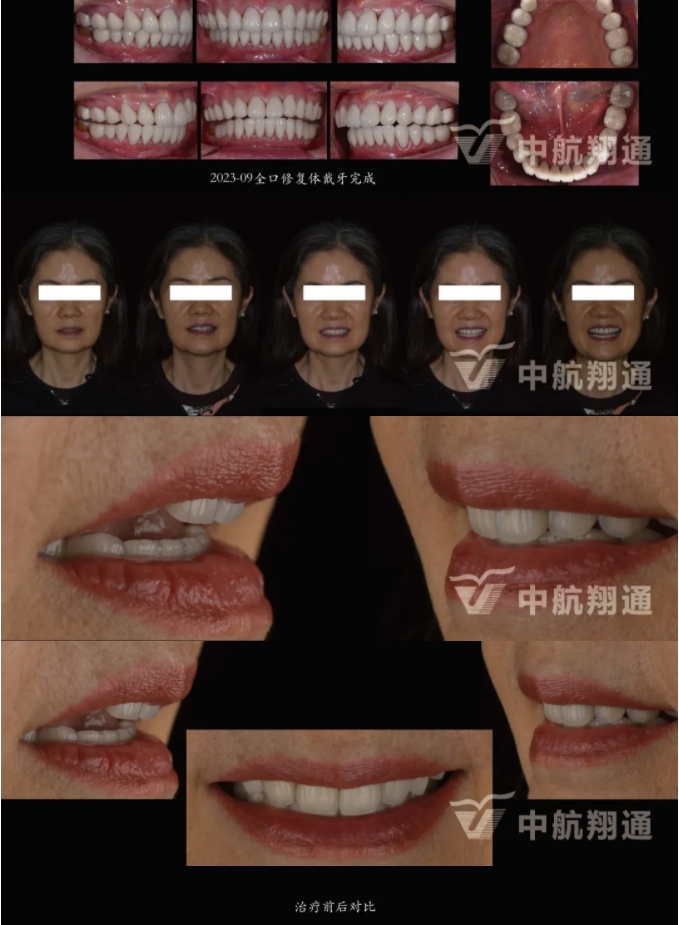 多學(xué)科聯(lián)合治療重度磨耗咬合重建?例