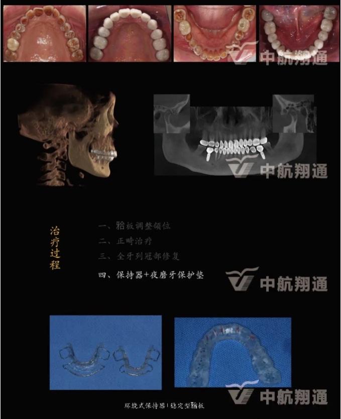 多學(xué)科聯(lián)合治療重度磨耗咬合重建?例