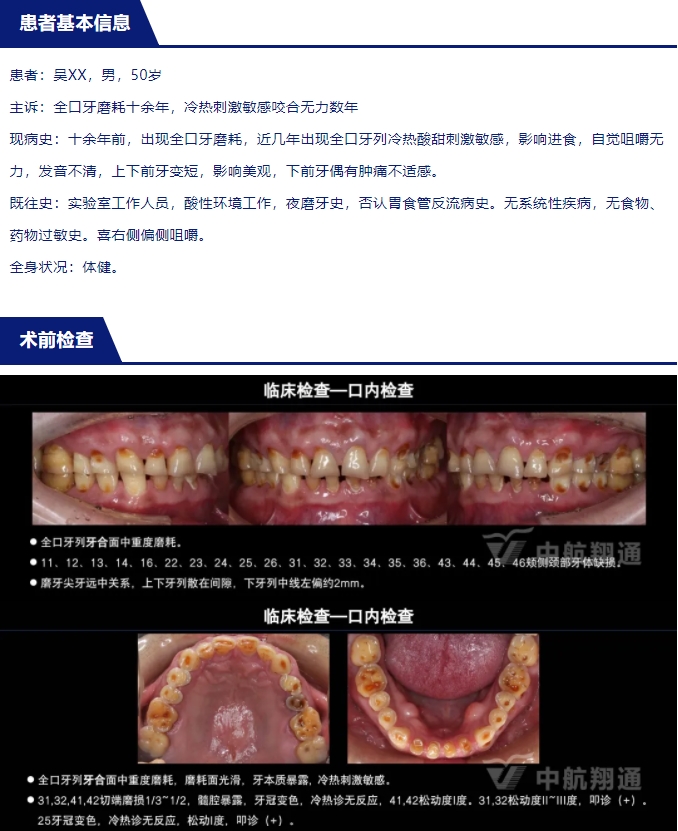2024華人美學臨床病例大賽獲獎病例|以美學設(shè)計為導向的牙列重度磨耗患者全牙列咬合重建