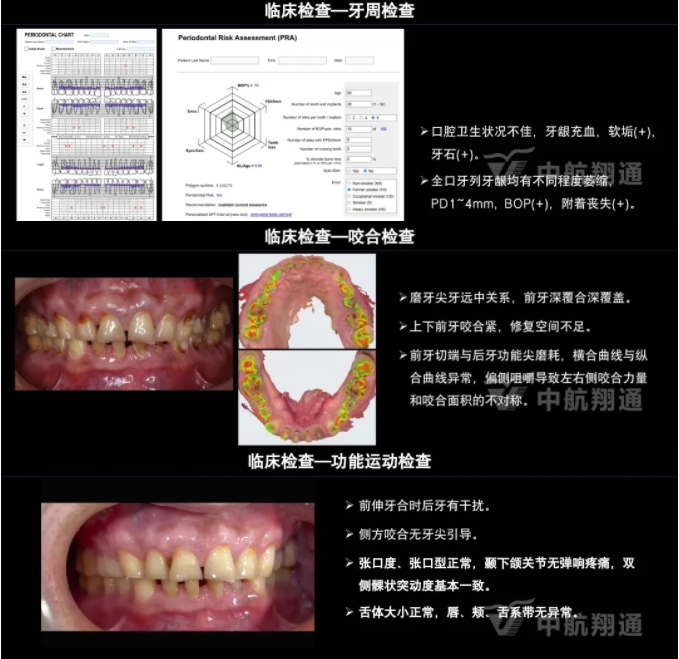 2024華人美學臨床病例大賽獲獎病例|以美學設(shè)計為導向的牙列重度磨耗患者全牙列咬合重建