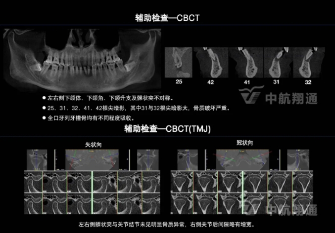 2024華人美學臨床病例大賽獲獎病例|以美學設(shè)計為導向的牙列重度磨耗患者全牙列咬合重建