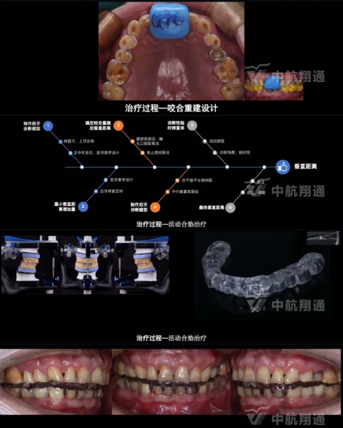 2024華人美學臨床病例大賽獲獎病例|以美學設(shè)計為導向的牙列重度磨耗患者全牙列咬合重建