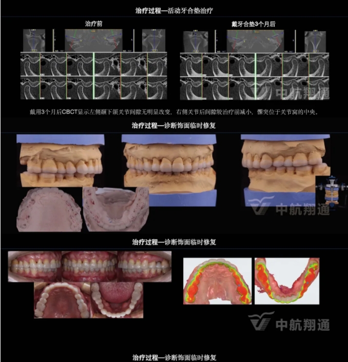 2024華人美學臨床病例大賽獲獎病例|以美學設(shè)計為導向的牙列重度磨耗患者全牙列咬合重建