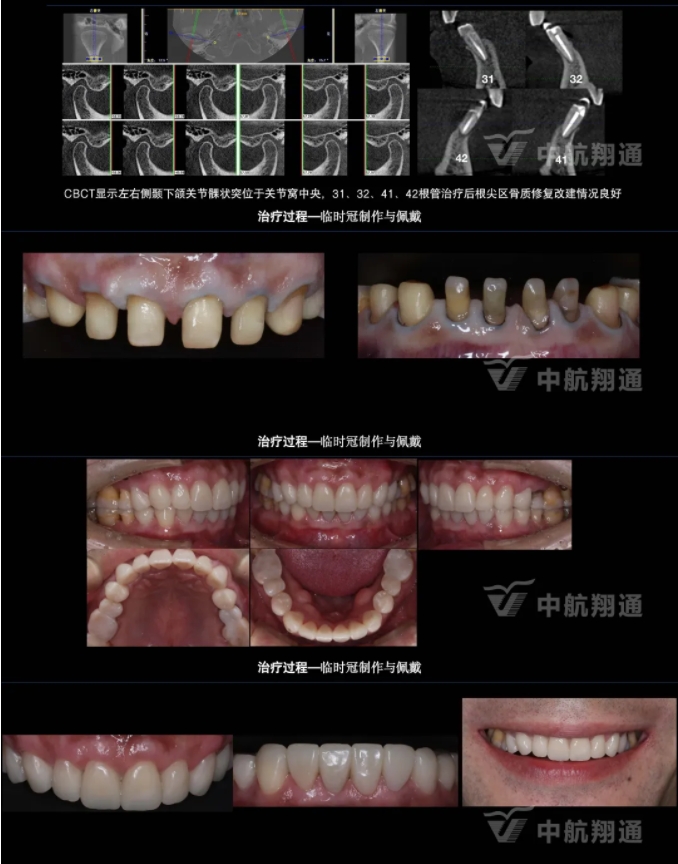 2024華人美學臨床病例大賽獲獎病例|以美學設(shè)計為導向的牙列重度磨耗患者全牙列咬合重建