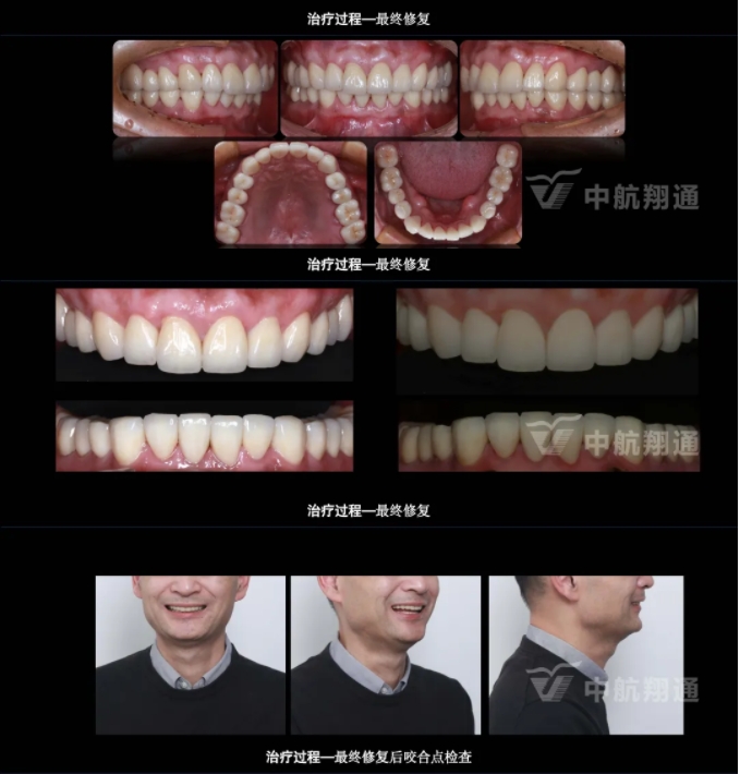2024華人美學臨床病例大賽獲獎病例|以美學設(shè)計為導向的牙列重度磨耗患者全牙列咬合重建