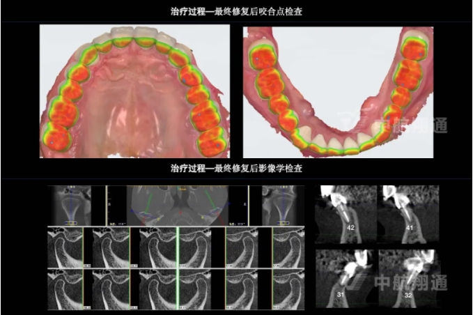 2024華人美學臨床病例大賽獲獎病例|以美學設(shè)計為導向的牙列重度磨耗患者全牙列咬合重建