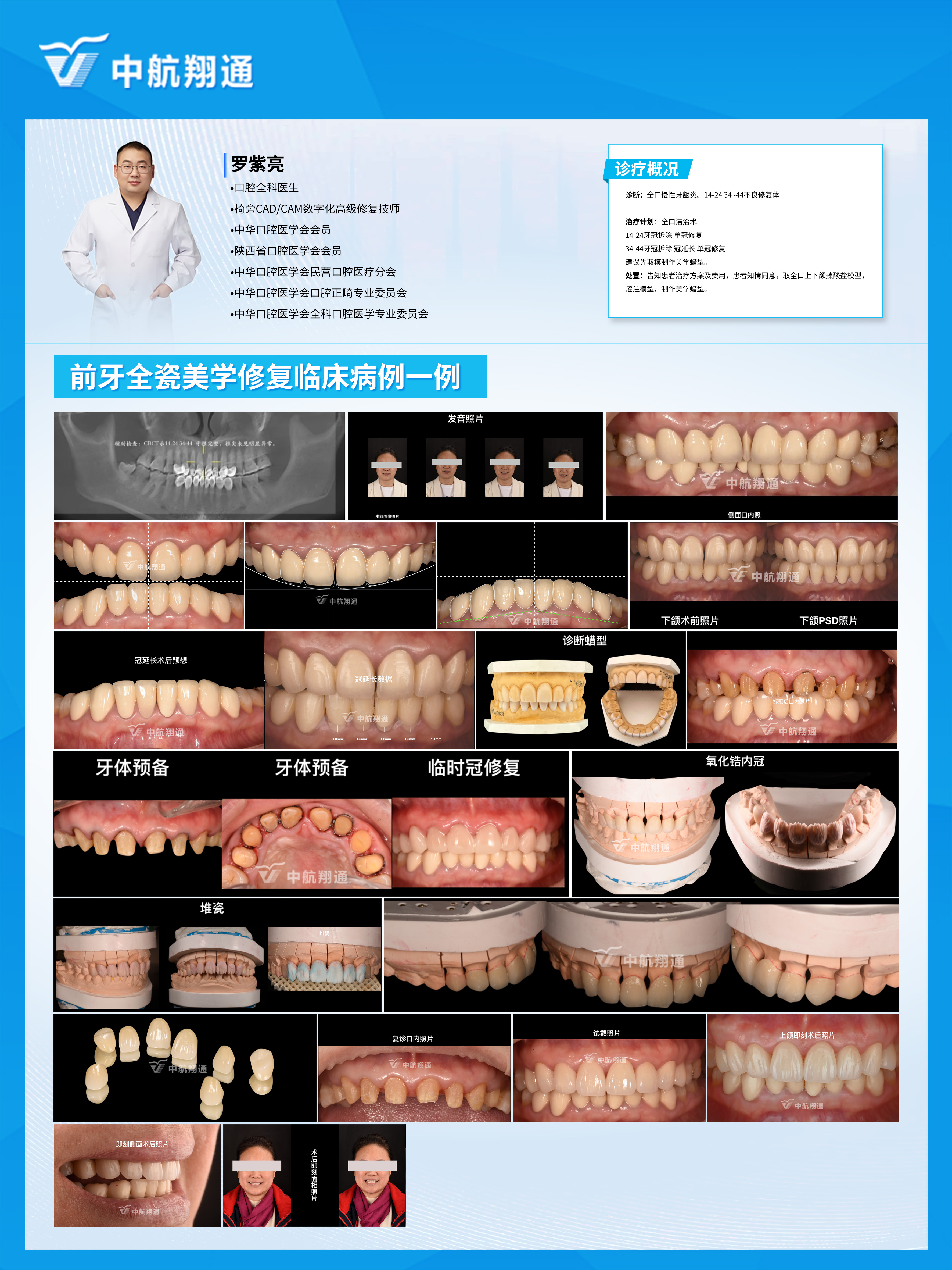 前牙區(qū)美學(xué)修復(fù)臨床病例?例|全冠修復(fù)病例分享